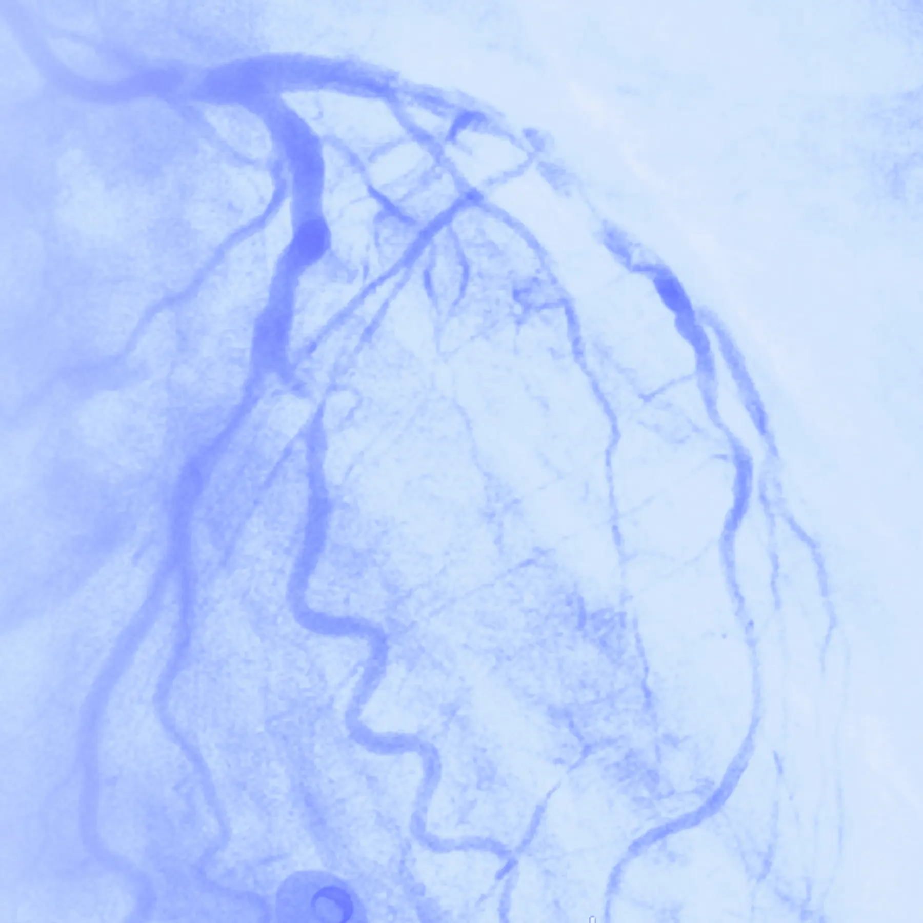 Складні ендоваскулярні втручання: CHIP-процедури, оклюзійні ураження та сучасні емболізаційні технології